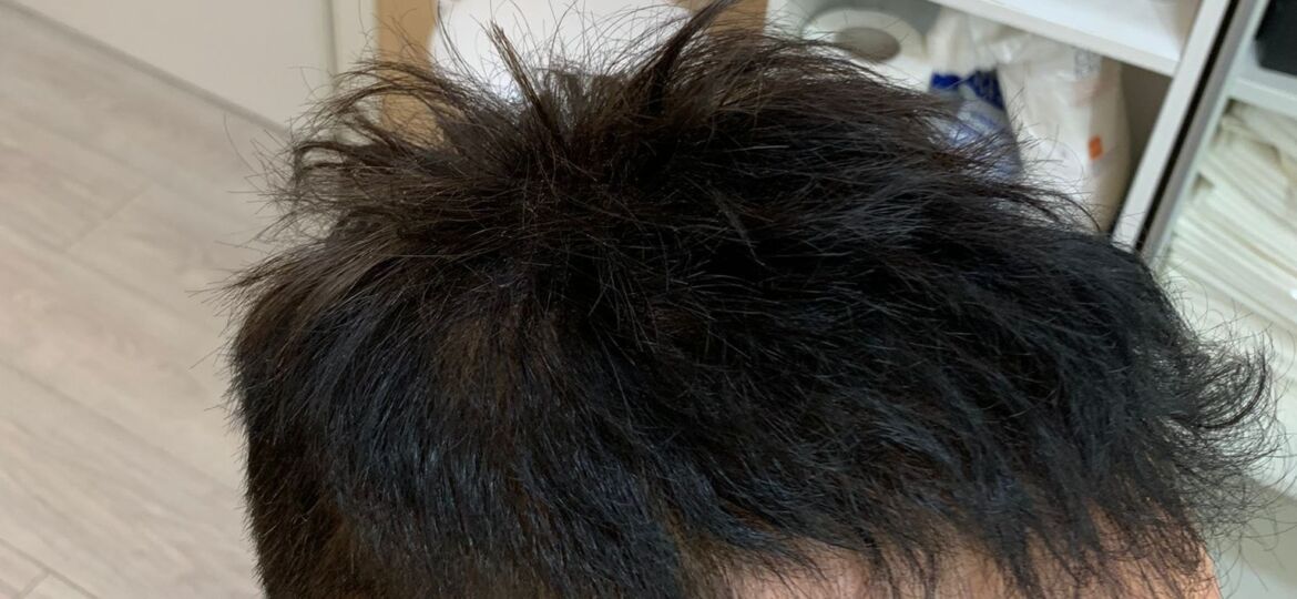 protesi capelli roma