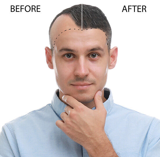 protesi-per-capelli-roma-prima-e-dopo