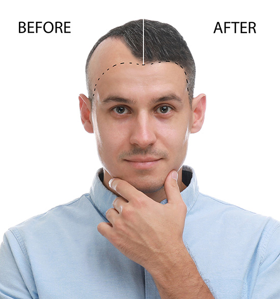 protesi-per-capelli-roma-prima-e-dopo